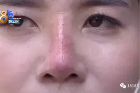 养生馆里隆鼻变红鼻子？找人“背锅”反被录音图片
