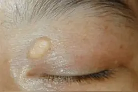眼睛出现这几种症状，可能是血脂出现波动，有些升高了，注意应对图片