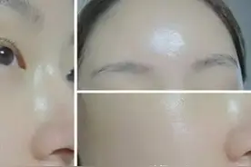 对比水光针“手打和机打”的优缺点图片