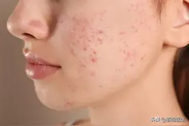 网红狂吹的“壬二酸”真是抗痘神器？那它这么多年咋默默无闻图片