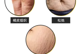 橘皮！松弛！这些胖过的“痕迹”，90%都可以改善图片