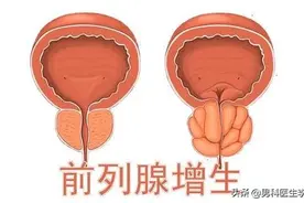 男性健康——前列腺肥大的自我检测图片