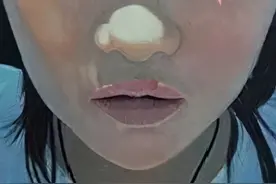 蒜头鼻作为公认最丑的鼻型，鼻尖如何矫正才能变美？图片