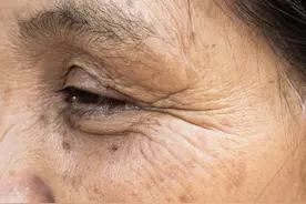 老年人眼圈发黑，要注意这些疾病图片