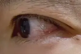 44岁男星眼睛受伤，视网膜剥离触目惊心，有可能永远无法痊愈图片