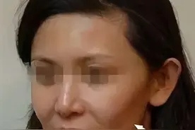 显老显丧的面颊凹陷应该如何改善图片