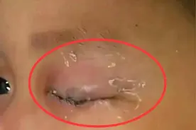 4岁女孩误把胶水，当眼药滴入眼睛，爸爸的急救操作，被医生直夸图片