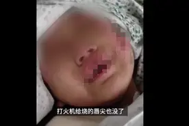 惨绝人寰！热水浇头、钳子拔牙…6岁女童遭亲妈虐待险丧命图片