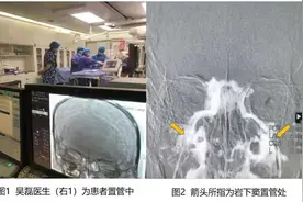 秦皇岛市第一医院内分泌科联合神经外科成功开展秦市首例岩下窦取血技术 成功精准定位诊断库欣病图片