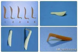 正解--隆鼻后假体外露咋整？图片