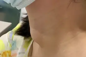 真实案例：乒乓球大小甲状腺结节，患者“吃饭像石头碾过喉咙”图片