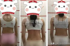 12岁女孩侧弯36°，治疗半年后减至11°图片