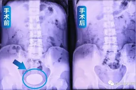 腹痛尿频尿急能缓解就没事？34岁男子膀胱内竟养出罕见巨大结石图片