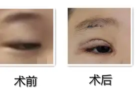眼睛无神，总感觉睡不醒，警惕！可能是上睑下垂【呱呱教·164】图片