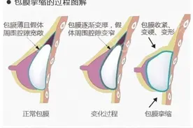 怎样预防假体隆胸术后包膜挛缩？图片