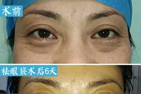 祛眼袋手术后，切口多久会掉痂？听听医生怎么说图片