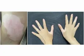 白癜风能根治吗？大家最想知道的5个白癜风问题图片