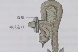 直肠癌做的保肛手术为什么还要开一个造口？图片