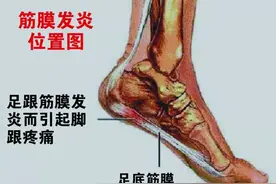 脚后跟为什么一踩地就疼？图片