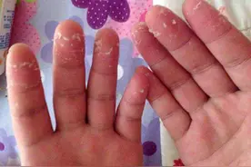 孩子老是手蜕皮只是干燥吗？还可能跟这三种疾病有关，可别大意图片