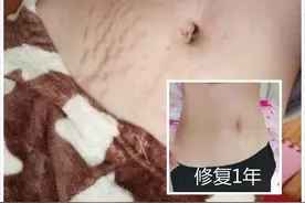 妊娠纹的形成其实是这样的，男人永远无法理解，网友：太形象了！图片