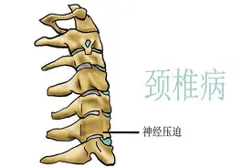 引起颈椎疼痛的原因有哪些？采取哪些措施进行治疗？图片