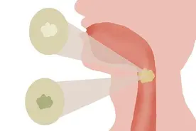 咳出来的痰，咽进肚子里，对身体有影响吗？图片