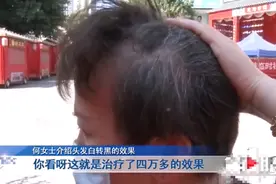 女子花4万做“白发转黑”，治疗过程就是拔白头发：每次都拔两三个小时图片