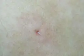 有痔疮的人，后腰常有小红点，里面藏着“棉花丝”？医生这样解释图片