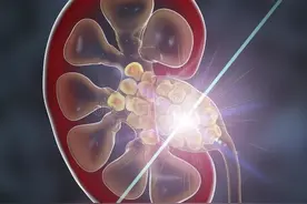 一颗肾结石的自白——快来看看我是如何毁掉你的大好肾脏？图片