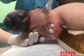 宝宝刚一出生就头顶个“大包”，危及生命！只因妈妈孕期忽视了这件事图片
