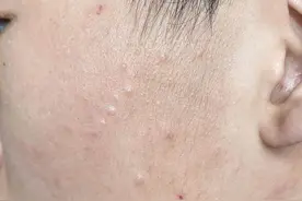 12岁男孩脸上长满痘！医生却说不是青春痘，并说这病具有传染性，咋回事？图片