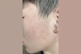 12岁男孩脸上长满痘！医生却说不是青春痘，并说这病具有传染性，咋回事？图片