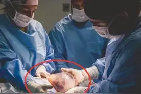 90后产妇生下"带壳宝宝"，丈夫以为孩子不健康，医生反连连祝贺图片
