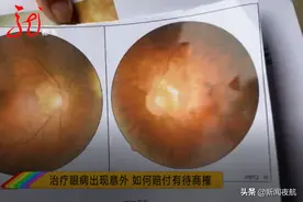 治疗眼病却出意外，原本的眼病没治好还多了一个问题，医院如何赔付有待商榷图片