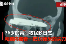 老人遭歹徒抢劫被捅，10厘米尖刀藏脑内26年！因无感把这事忘了……图片