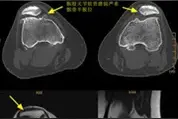 髌股关节紊乱症，一个需要及早就医的疾病图片
