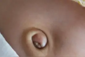 宝宝脐茸根除小妙招，少受罪少花钱图片