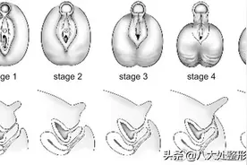 性发育异常（两性畸形），你该知道的事情图片