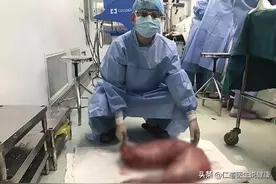 3年没排过一次大便，被36斤大便活活憋死，巨型结肠被无数人参观图片