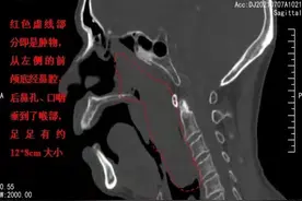 12cm！罕见巨大鼻息肉竟从鼻子卡入喉咙图片