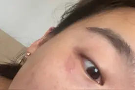 切记别拍！网友脸上爬隐翅虫，险些毁容图片