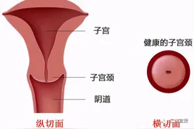 LEEP手术知多少？图片