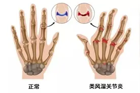 类风湿关节炎新药来了，疗效更好，有望治愈图片