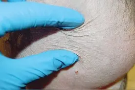 猫肾上腺疾病｜库欣综合征，即肾上腺皮质机能亢进，预后有保障图片