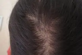 小时候头发少发际线高基本算秃顶，妈妈用一招让现在的我头发茂盛图片