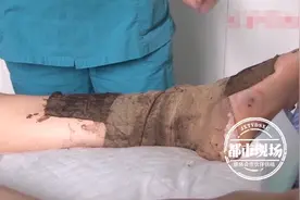 女子被蛇咬伤血流不止，回家后竟用药酒冲洗，差点出大事图片
