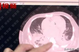 男子反复肺炎不愈，竟是“超级细菌”在作祟图片