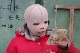 9岁女孩整天戴“面具”示人，受同龄人嘲笑，可摘下之后让人落泪图片