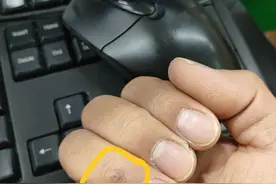 手指上不知道长了一个什么东西，有没有认识的图片